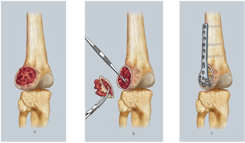 Dr. Suman Byregowda performing curettage procedure for benign bone tumor